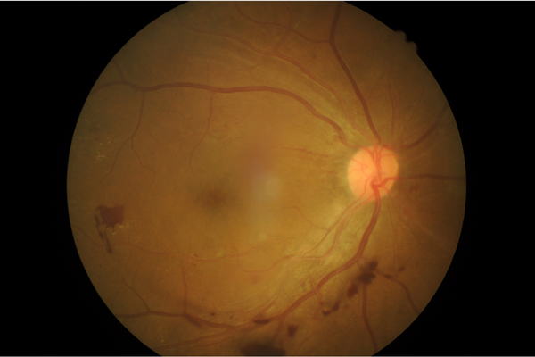 Imagen de desprendimiento de retina